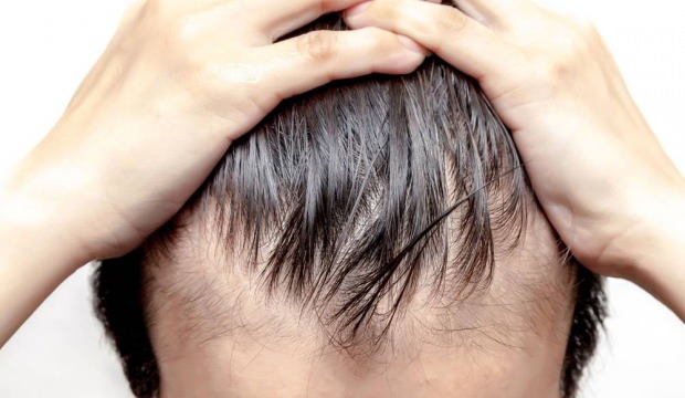 Saç Dökülmesinin Cerrahi Tedavileri